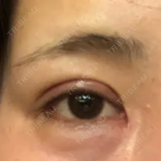 47日目の経過画像（1枚目）