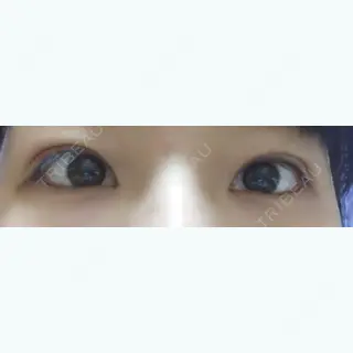 13日目の経過画像（1枚目）