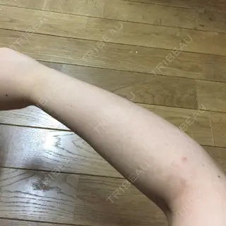 36日目の経過画像（2枚目）