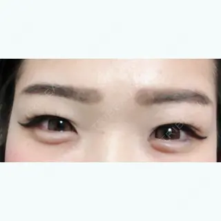 0日目の経過画像（1枚目）
