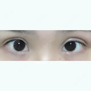6日目の経過画像（1枚目）
