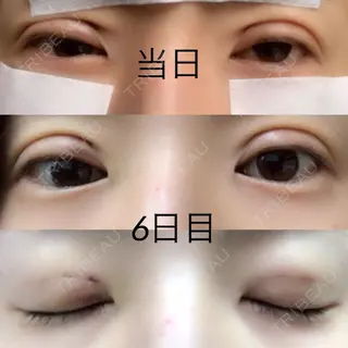 6日目の経過画像（1枚目）