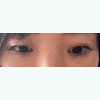 96日目の経過画像（1枚目）
