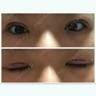 4日目の経過画像（1枚目）