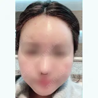 2日目の経過画像（1枚目）