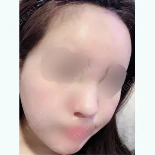 3日目の経過画像（1枚目）