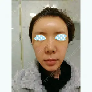 1日目の経過画像（1枚目）