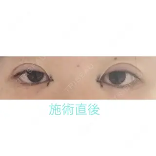 0日目の経過画像（1枚目）
