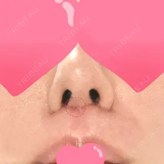 32日目の経過画像（2枚目）