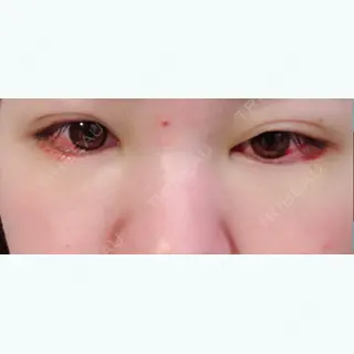 4日目の経過画像（1枚目）