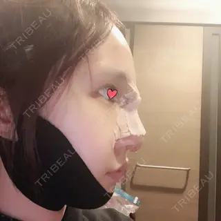 0日目の経過画像（3枚目）