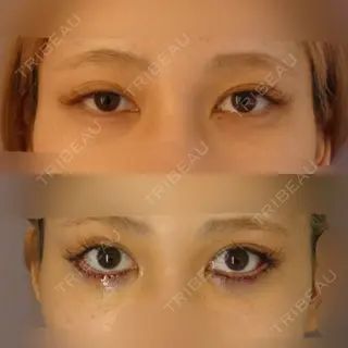 0日目の経過画像（2枚目）