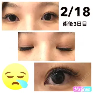 3日目の経過画像（1枚目）