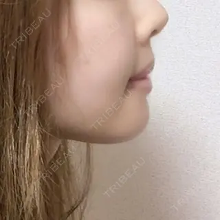 17日目の経過画像（3枚目）