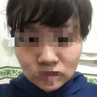 5日目の経過画像（1枚目）