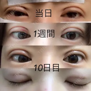 10日目の経過画像（1枚目）