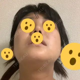 49日目の経過画像（3枚目）