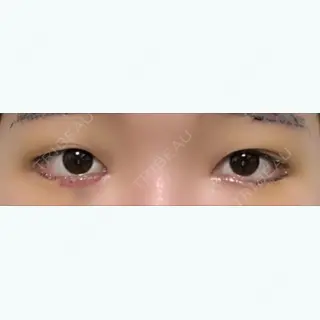 4日目の経過画像（1枚目）