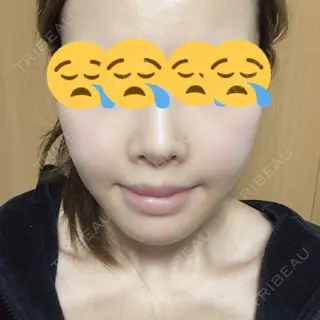 18日目の経過画像（1枚目）