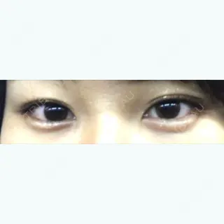 2日目の経過画像（2枚目）