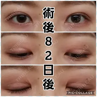 82日目の経過画像（1枚目）