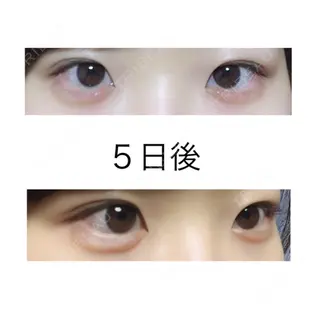 5日目の経過画像（1枚目）