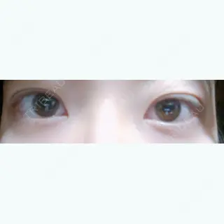 0日目の経過画像（1枚目）