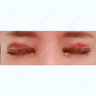 1日目の経過画像（1枚目）