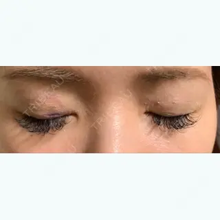 3日目の経過画像（3枚目）