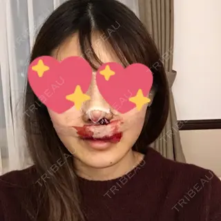 0日目の経過画像（1枚目）