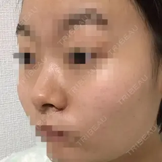 0日目の経過画像（2枚目）