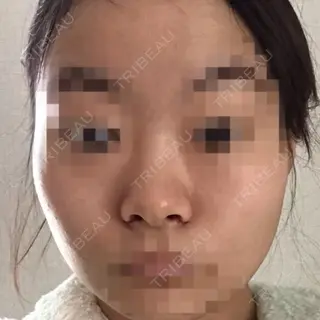 2日目の経過画像（1枚目）