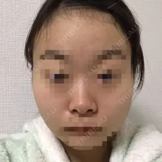 3日目の経過画像（1枚目）