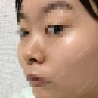 5日目の経過画像（2枚目）
