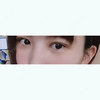 8日目の経過画像（1枚目）