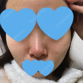 11日目の経過画像（1枚目）