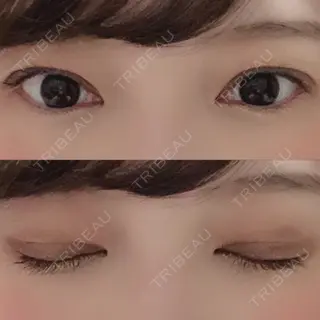 33日目の経過画像（1枚目）