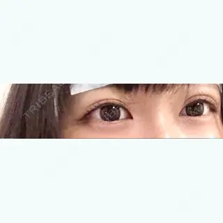 5日目の経過画像（1枚目）