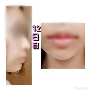 12日目の経過画像（1枚目）