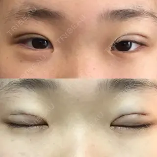 0日目の経過画像（1枚目）