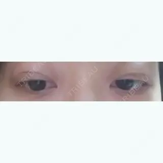 2日目の経過画像（3枚目）