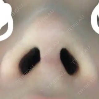 12日目の経過画像（3枚目）
