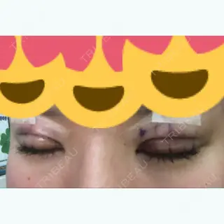 2日目の経過画像（2枚目）