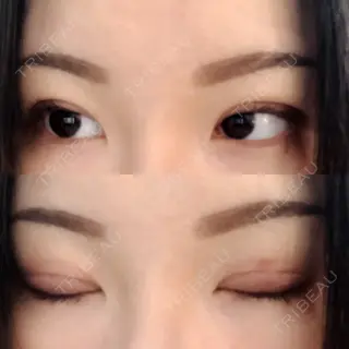 5日目の経過画像（1枚目）