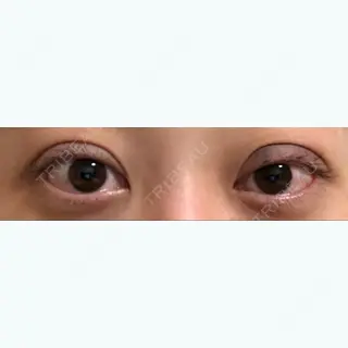 0日目の経過画像（1枚目）