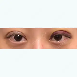 1日目の経過画像（1枚目）