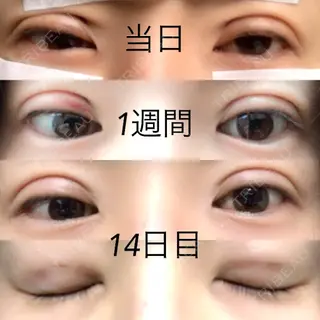 15日目の経過画像（1枚目）