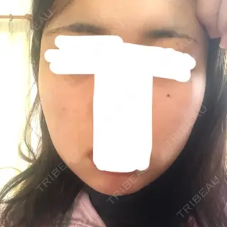 6日目の経過画像（1枚目）