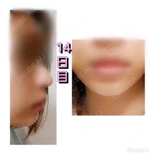 14日目の経過画像（1枚目）