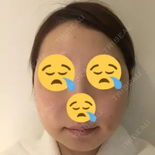 6日目の経過画像（1枚目）